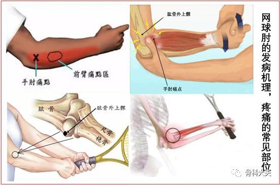 网球肘